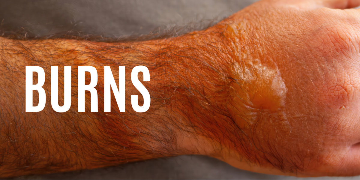 What Everyone Should Know About Burn Injuries – Refuge Medical